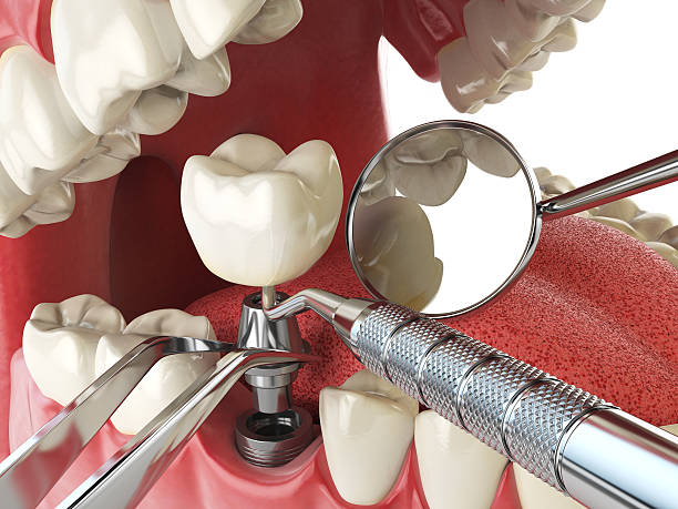 Best Emergency Wisdom Teeth Removal in Canal Winchester, OH